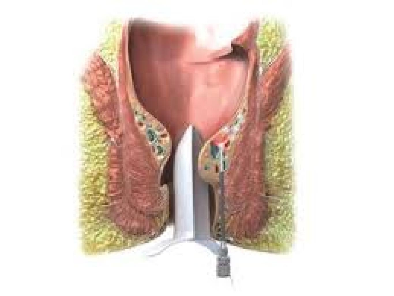 ლაზერული ჰემოროიდოპლასტიკა - LHP® (Laser Hemorrhoidoplasty)